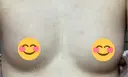 豊胸（脂肪注入） 銀座マイアミ美容外科 AFTER サムネイル用