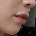 ヒアルロン酸注入（唇） Wi Clinic （ウィ クリニック）心斎橋院 DAY 1 サムネイル用