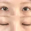 二重埋没 オアシス美容外科 DAY 10 サムネイル用