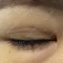 二重埋没 / 自然癒着法 Brandnew Beauty Clinic DAY 8 サムネイル用