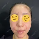 ヒアルロン酸注入（あご） / ヒアルロン酸注入（額） / ヒアルロン酸注入（鼻翼基部） 藤・ナチュレ美容クリニック 銀座院 AFTER サムネイル用