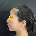 ヒアルロン酸注入（あご） / ヒアルロン酸注入（額） / ヒアルロン酸注入（鼻翼基部） 藤・ナチュレ美容クリニック 銀座院 DAY 0 サムネイル用