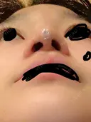 軟骨移植 三輪皮フ科形成外科 DAY 5 サムネイル用