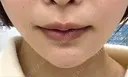 ボトックス（あご） / ヒアルロン酸注入（あご） PRO CLINIC プロクリニック 銀座院 AFTER サムネイル用