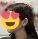 糸リフト / 脂肪吸引（顔） 脂肪吸引ラボトウキョウ DAY 81 サムネイル用