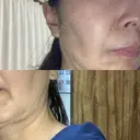 ルメッカ BAO CLINIC 神戸院 DAY 7 サムネイル用