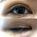 二重埋没 / 自然癒着法 Brandnew Beauty Clinic DAY 10 サムネイル用