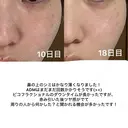 肌育注射（ジュベルックなど） / シミ取りレーザー / ピコレーザートーニング（美白・肝斑） / ピコフラクショナルレーザー（毛穴・ニキビ跡） 東京シルククリニック 新宿院 DAY 18 サムネイル用