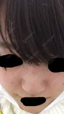 軟骨移植 三輪皮フ科形成外科 DAY 7 サムネイル用