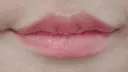 口唇縮小術 くさのたろうクリニック DAY 7 サムネイル用