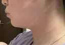 RF（高周波）たるみ治療 CIEL SKIN CLINIC（シエルスキンクリニック） DAY 3 サムネイル用