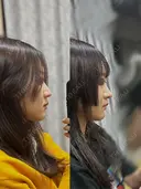 鼻尖形成（切開） / 軟骨移植 / 鼻柱下降・鼻唇角形成（猫手術） 東京美専クリニック DAY 39 サムネイル用