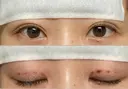 二重埋没 Stand by Beauty Clinic DAY 0 サムネイル用