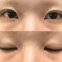 二重埋没 オアシス美容外科 AFTER サムネイル用