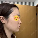 肌ヒアルロン酸注入（たるみ・シワ改善） / ヒアルロン酸注入（あご） / ボトックス（エラ・小顔） / ヒアルロン酸注入（唇） / ボトックス（額） HAAB×DREAM BEAUTY CLINIC 大阪梅田院 DAY 0 サムネイル用