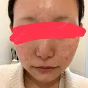 肌育注射（ジュベルックなど） 城本クリニック 池袋院 DAY 0 サムネイル用