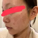 肌育注射（ジュベルックなど） 城本クリニック 池袋院 DAY 0 サムネイル用
