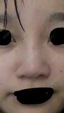 軟骨移植 三輪皮フ科形成外科 AFTER サムネイル用