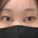 目頭切開 Brandnew Beauty Clinic DAY 0 サムネイル用