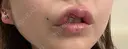 その他（口元） アネシス美容クリニック DAY 6 サムネイル用