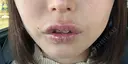 その他（口元） アネシス美容クリニック DAY 7 サムネイル用