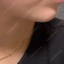 ボトックス（あご） フォンタナクリニック天神 DAY 11 サムネイル用