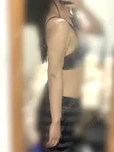 脂肪吸引（二の腕） / 脂肪吸引（背中） オアシス美容外科 DAY 32 サムネイル用