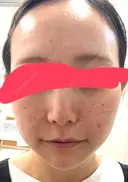 肌育注射（ジュベルックなど） 城本クリニック 池袋院 AFTER サムネイル用