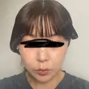 鼻尖形成（切開） / 小鼻縮小（切開） / 軟骨移植 ASTRA BEAUTY CLINIC DAY 15 サムネイル用