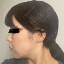 鼻尖形成（切開） / 小鼻縮小（切開） / 軟骨移植 ASTRA BEAUTY CLINIC DAY 15 サムネイル用