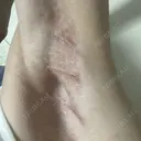 ワキ汗治療（切開） 石倉クリニック 水戸院 AFTER サムネイル用