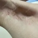 ワキ汗治療（切開） 石倉クリニック 水戸院 DAY 334 サムネイル用