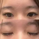 二重埋没 よだ形成外科クリニック AFTER サムネイル用