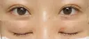 二重埋没 Stand by Beauty Clinic DAY 3 サムネイル用