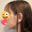 糸リフト / ピーリング（ニキビ・毛穴） / エレクトロポレーション アリエル美容クリニック 横浜院 DAY 14 サムネイル用