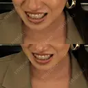 矯正（ワイヤー） Shiny Teeth Clinic 【シャイニー ティース クリニック】 AFTER サムネイル用