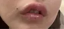 その他（口元） アネシス美容クリニック DAY 8 サムネイル用