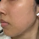 ピーリング（ニキビ・毛穴） / 光治療（フォトフェイシャルなど） Lumiera Clinic DAY 0 サムネイル用