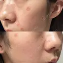 ほくろ・いぼ除去レーザー（肌） Kaleido Clinic（カレイドクリニック） 横浜 DAY 0 サムネイル用