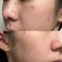 ほくろ・いぼ除去レーザー（肌） Kaleido Clinic（カレイドクリニック） 横浜 AFTER サムネイル用
