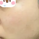 ピーリング（ニキビ・毛穴） / イオン導入 / ルメッカ ルラ美容クリニック 上野院 AFTER サムネイル用