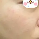 ピーリング（ニキビ・毛穴） / イオン導入 / ルメッカ ルラ美容クリニック 上野院 DAY 1 サムネイル用