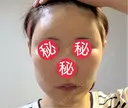 額を丸く / 脂肪注入（肌） / 脂肪注入（額） 湘南美容クリニック 柏院 DAY 33 サムネイル用