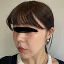 鼻尖形成（切開） / 小鼻縮小（切開） / 軟骨移植 ASTRA BEAUTY CLINIC DAY 19 サムネイル用