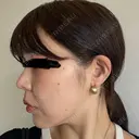 鼻尖形成（切開） / 小鼻縮小（切開） / 軟骨移植 ASTRA BEAUTY CLINIC DAY 19 サムネイル用