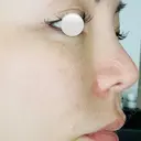 隆鼻術 / 鼻尖形成（切開） / 小鼻縮小（切開） / 軟骨移植 / 眉間プロテーゼ / 鼻修正 / 鼻尖縮小 / 鼻柱下降・鼻唇角形成（猫手術） / その他（鼻） グローバルビューティークリニック 銀座院 DAY 93 サムネイル用