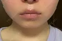 RF（高周波）たるみ治療 CIEL SKIN CLINIC（シエルスキンクリニック） DAY 9 サムネイル用