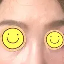 その他（目元） アネシス美容クリニック AFTER サムネイル用