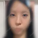 目頭切開 / 小鼻縮小（切開） / 鼻尖形成（非切開） アネシス美容クリニック DAY 18 サムネイル用