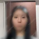 目頭切開 / 小鼻縮小（切開） / 鼻尖形成（非切開） アネシス美容クリニック DAY 35 サムネイル用